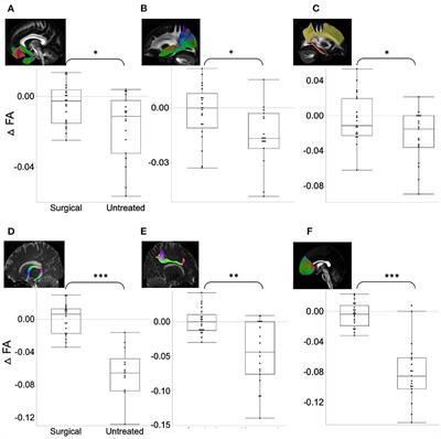 White matter microstructure and connectivity changes after surgery in male adults with obstructive sleep apnea: recovery or reorganization?
